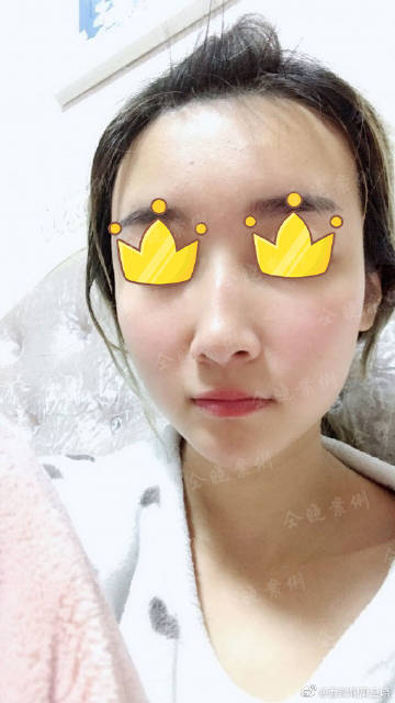  表情自体脂肪填充面部表情