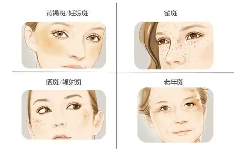  不同的斑会有哪些区别