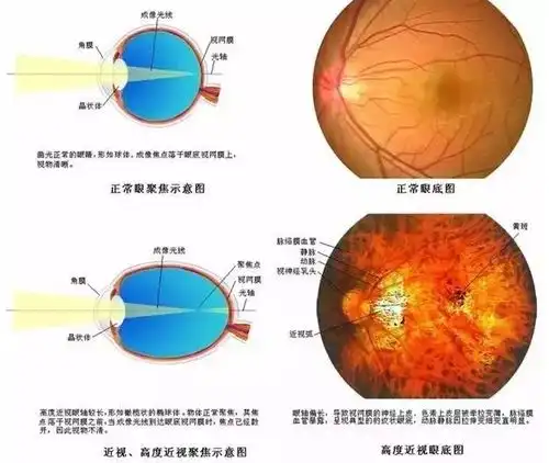  高度近视只是近视度数高了点吗no高度近视致盲人数已超30万