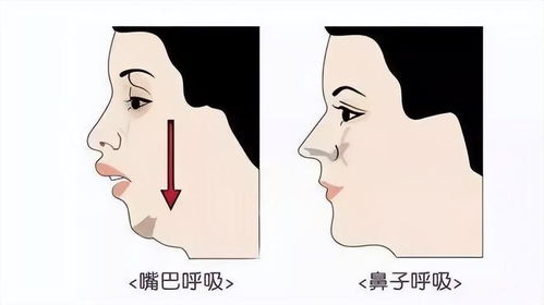  1药网用嘴呼吸影响颜值专家提示长期这样会对健康造成影响
