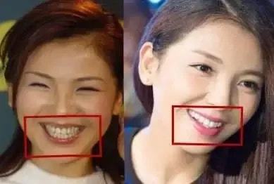  刘涛牙疼,助理赶紧去医院,你一口牙300万,坏一颗10万就没了