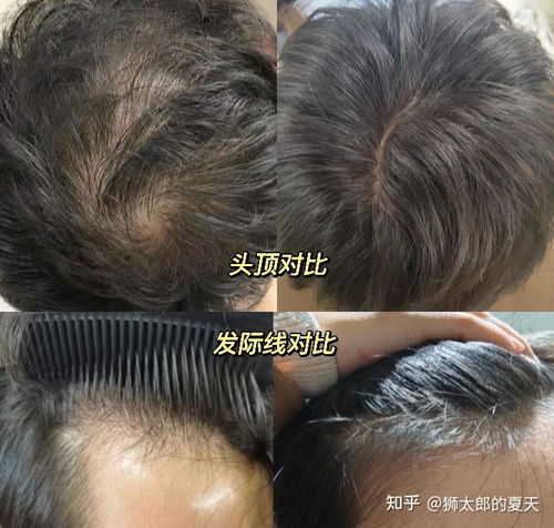  秃头医生自救指南我们经常喝的瑞幸星巴克里面的咖啡因竟然能防脱发欧倍青防脱洗发水真的比米诺地尔还要好用吗