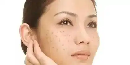  脸上出现这三种东西,别着急护肤,可能是妇科病