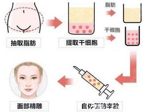  全脸自体脂肪填充后,表情还自然吗