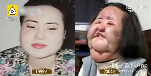  往脑部灌机油修复手术17次...她因整容上瘾毁掉了人生