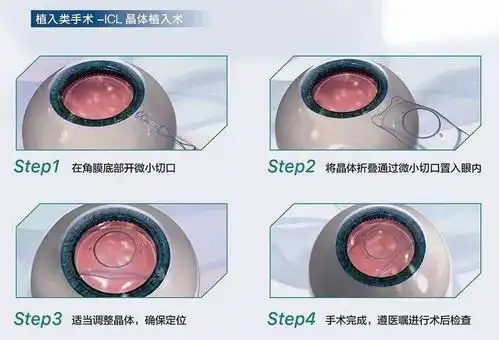  近视手术高科技不用每天摘戴的隐形眼镜