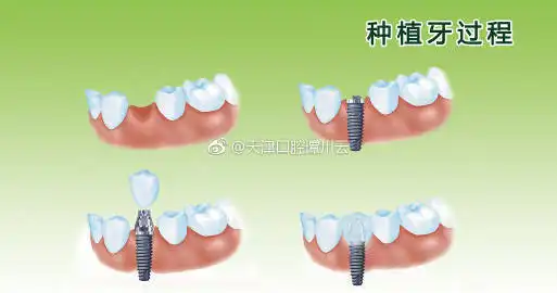 中老年人表情包素材种植牙