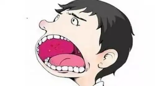 口腔溃疡为什么反复原先不仅是上火这么简单  口腔溃疡为什么反复原先不仅是上火这么简单