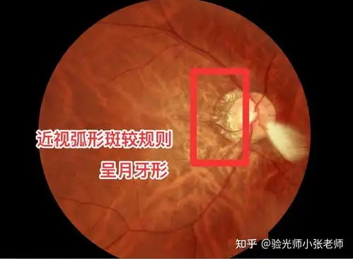  高度近视不可怕,可怕的是眼底病变