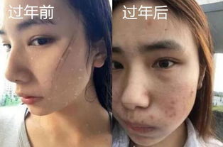 胖肉表情包痘痘